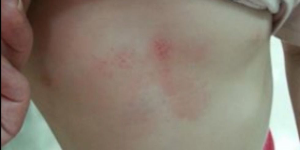 See This Little Girl's Chest Bruises? It Means Her Mom Did Something RIGHT