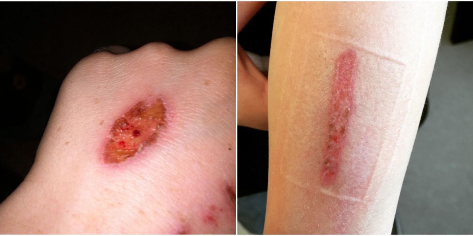 Schools Warning Parents About Eraser Challenge Eraser Challenge